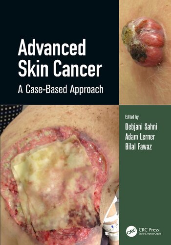 Advanced Skin Cancer: A Case-Based Approach (PDF/EPUB Version)