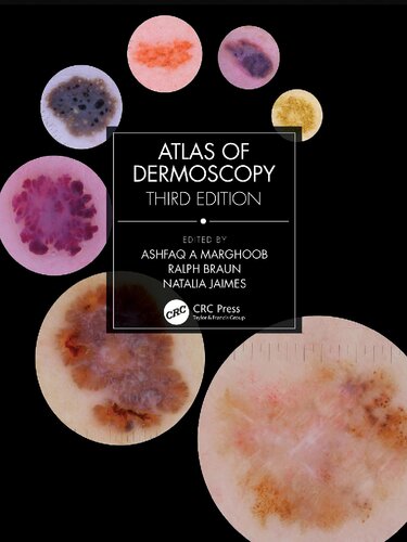 Atlas of Dermoscopy: (PDF/EPUB Version)