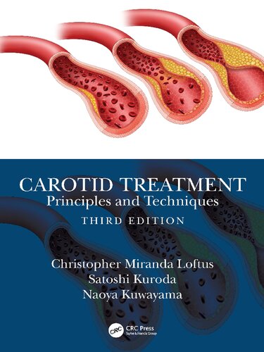 Carotid Treatment: Principles and Techniques (PDF/EPUB Version)